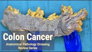 Colon Cancer  Anatomical Pathology Grossing Review Series [upl. by Gnak112]