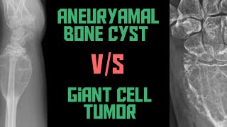 Giant Cell Tumor VS Aneurysmal Bone cyst  GCT VS ABC  Xrays  Image bases  Radiology [upl. by Jochebed749]