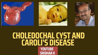 Choledochal cyst and Carolis disease Neonatal cholestasis choledochalcyst carolidisease [upl. by Sida]