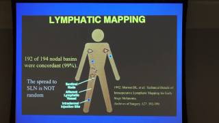 Sentinel Lymph Node Biopsy in the Surgical Management of Melanoma [upl. by Basset]