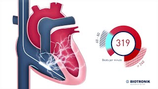 Implantable Cardioverter Defibrillator  How it works [upl. by Arehs472]