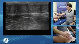 Sonographic assessment of the lateral knee for POCUS clinicians [upl. by Ahsiaa]