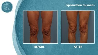 Lipo of knees [upl. by Filbert]