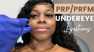 PRPPRFM Under Eye Injections  DARK CIRCLES AND VOLUME LOSS UNDER YOUR EYES [upl. by Jaquiss]