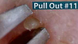 11 Pull Out Blackheads Close up  Blackheads Removal [upl. by Ademla72]