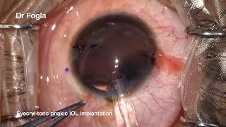 Eyecryl Toric Phakic IOL implantation [upl. by Ynatirb]