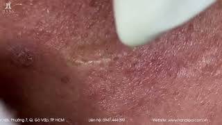 Big Cystic Acne Blackheads Extraction Blackheads amp Milia Whiteheads Removal Pimple Popping [upl. by Aibonez585]