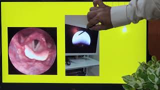 Acute Epiglottitis  ENT EMERGENCY  Urdu  Patient teaching programme [upl. by Haliak]