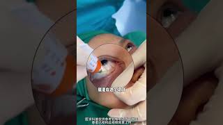 How to apply eye ointment medical plasticandbeauty 搞笑 plastic [upl. by Kcirdahc]