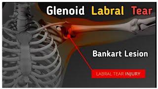 Glenoid labrum tear  Bankart lesion labraltear shoulderdislocation shorts [upl. by Wehner821]