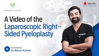 A Video of the Laparoscopic Right Sided Pyeloplasty  Dr Barun Kumar  Urologist [upl. by Cl]