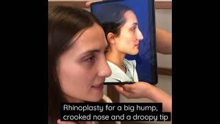 Rhinoplasty for Crooked Nose w Large Hump and Drooping Tip  Houston Nose Surgeon Dr Michel Siegel [upl. by Arual]