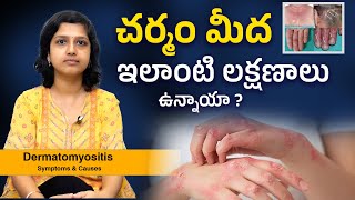 Dermatomyositis Telugu Symptoms amp Causes  Sindhura Kambhampati [upl. by Ripleigh]