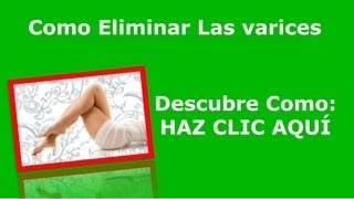 Como Eliminar Las Varices  Quitar Las Varices Con Acupuntura [upl. by Esinal]