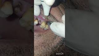 جير الاسنان ادى لانحسار اللثة  تنظيف  dentist stitch [upl. by Navanod848]