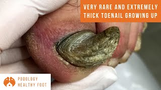 VERY RARE and extremely thick toenail that grows upwards asmr TOENAIL TRANSFORMATION [upl. by Ailido]