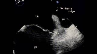 Warfarin ridge or LA clot to drahmadmirdamadisikcDwGso5hud2 [upl. by Mears631]