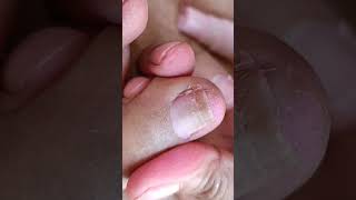 Cleaning ingrown toenailpedicure nails subcribe satisfying shortvideo [upl. by Sivie]