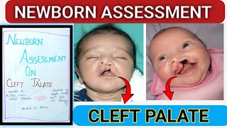 Cleft Palate Assessment  Newborn Assessment On cleft Palate Baby [upl. by Akiehs304]