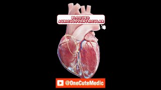 BLOQUEO AURÍCULOVENTRICULAR  MOBITZ I y II  OneCuteMedic [upl. by Polito]