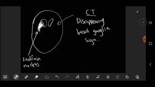 neuroradiology  Disappearing basal ganglia sign  early sign of infarction [upl. by Niltyak]