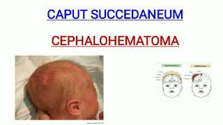 Caput succedaneum and cephalohematoma [upl. by Collum888]