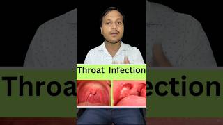 Throat Infection And Treatment medicine yt [upl. by Isidoro280]