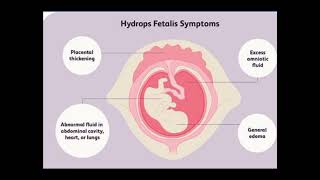 HYDROPS FETALIS ULTRASOUND FEATURES [upl. by Atcele728]