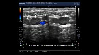 Ultrasound Video showing Mesenteric lymphadenitis enlarged mesenteric lymph nodes [upl. by Laius948]