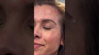 Botox lateral brow lift 25 units each side botox aesthetics aestheticdoctor [upl. by Eenat971]