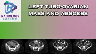 Left tuboovarian mass and abscess [upl. by Assi]