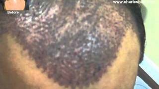 Charles Medical Group 41 yrold FUG Hair Procedure 2263 Grafts Video [upl. by Aerdna]