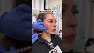 Facial Harmonization Before and After ❤️ pdothreads facelift IGsgaestheticsny [upl. by Usanis]