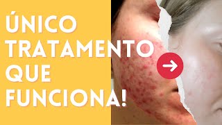 Quais Produtos Usar para ELIMINAR A ACNE FÚNGICA  Rotina passo a passo para limpar sua pele ✨ [upl. by Brazee]