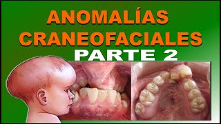 MALFORMACIONES CRANEOFACIALES O ANOMALIAS CONGENITAS DE DESARROLLO FACIAL PARTE 2 [upl. by Moor]