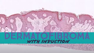 Dermatofibroma with induction phenomenon pathology dermpath dermatology dermatopathology [upl. by Danais]