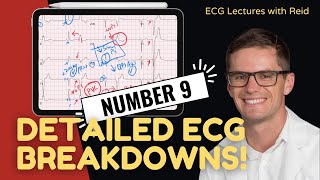 EKG Test Yourself  ECG Case Study 9 [upl. by Merrile]