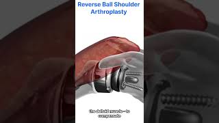 Reverse Ball Shoulder ArthroplastyRevolution for Cuff Tear Arthropathy 역구형 어깨 인공관절 수술 어깨관절염 수술의 혁신 [upl. by Hausmann]