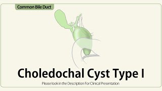 Choledochal Cyst Type I [upl. by Annadal457]