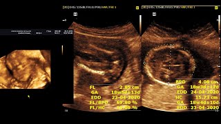 Ultrasound cases 130 of 2000  Video Showing 18wks of normal pregnancy [upl. by Ayhtin]