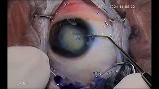 Complicated cataract with fibrosed anterior capsule in a young hyperopic patient [upl. by Rhoads]