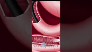 PreOp® Upper GI Endoscopy Patient Experience 👩‍⚕️ preop shorts health 🏥 [upl. by Lareneg]