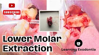 lower molar extraction  molar extraction  mandibular molar extraction dentistry dentist dental [upl. by Emsoc]