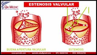 QX MEDIC  VALVULOPATIAS [upl. by Eboj]
