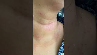 Wart Removal at Miracles Salon Colombo shorts [upl. by Fem]