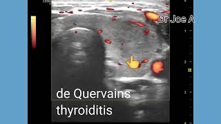 De Quervains thyroiditis or subacute granulomatous thyroiditis ultrasound and color Doppler video [upl. by Graybill]