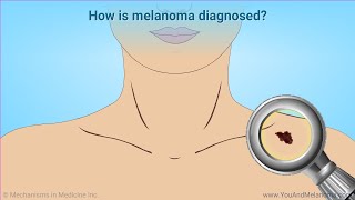 Diagnosing Melanoma [upl. by Ahsinot]