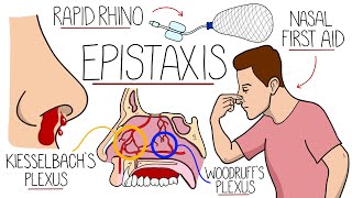 Understanding Epistaxis Nosebleeds Explained [upl. by Dwain]