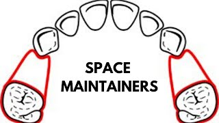 Space Maintainers in Orthodontics [upl. by Les]