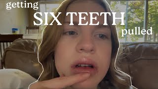 getting my WISDOM TEETH and TWO baby teeth pulled… vlog amp recovery [upl. by Akeinahs732]